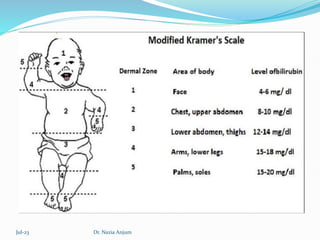 Kramer Test Neonatal Jaundice I Yarqan (Unani Concept).pptx
