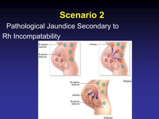 Pathologic Jaundice NEONATAL JAUNDICE.power point presentation | PPT