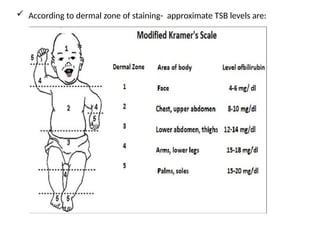  According to dermal zone of staining- approximate TSB levels are:
 