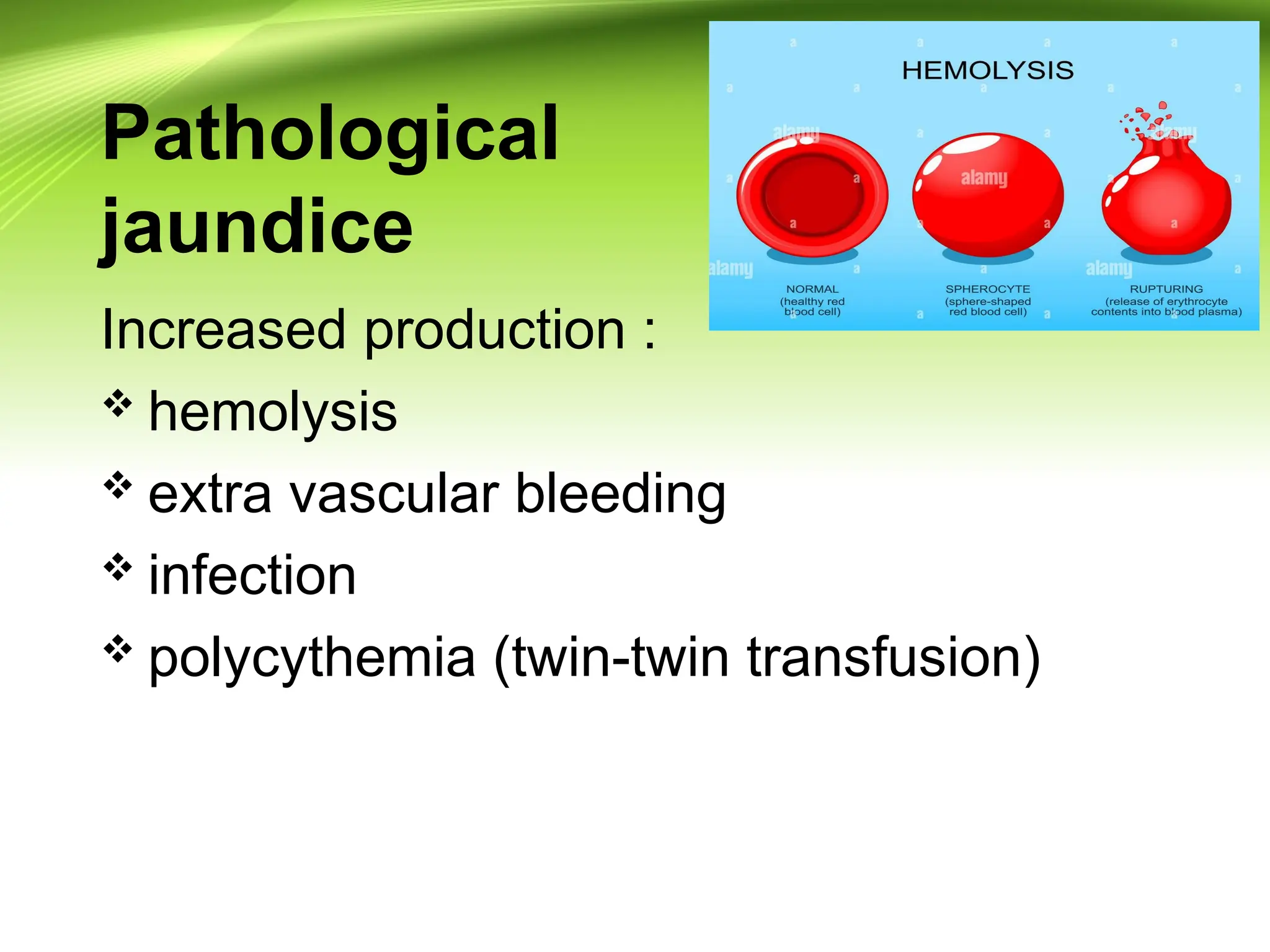 Pathological
jaundice
Increased production :
 hemolysis
 extra vascular bleeding
 infection
 polycythemia (twin-twin transfusion)
 