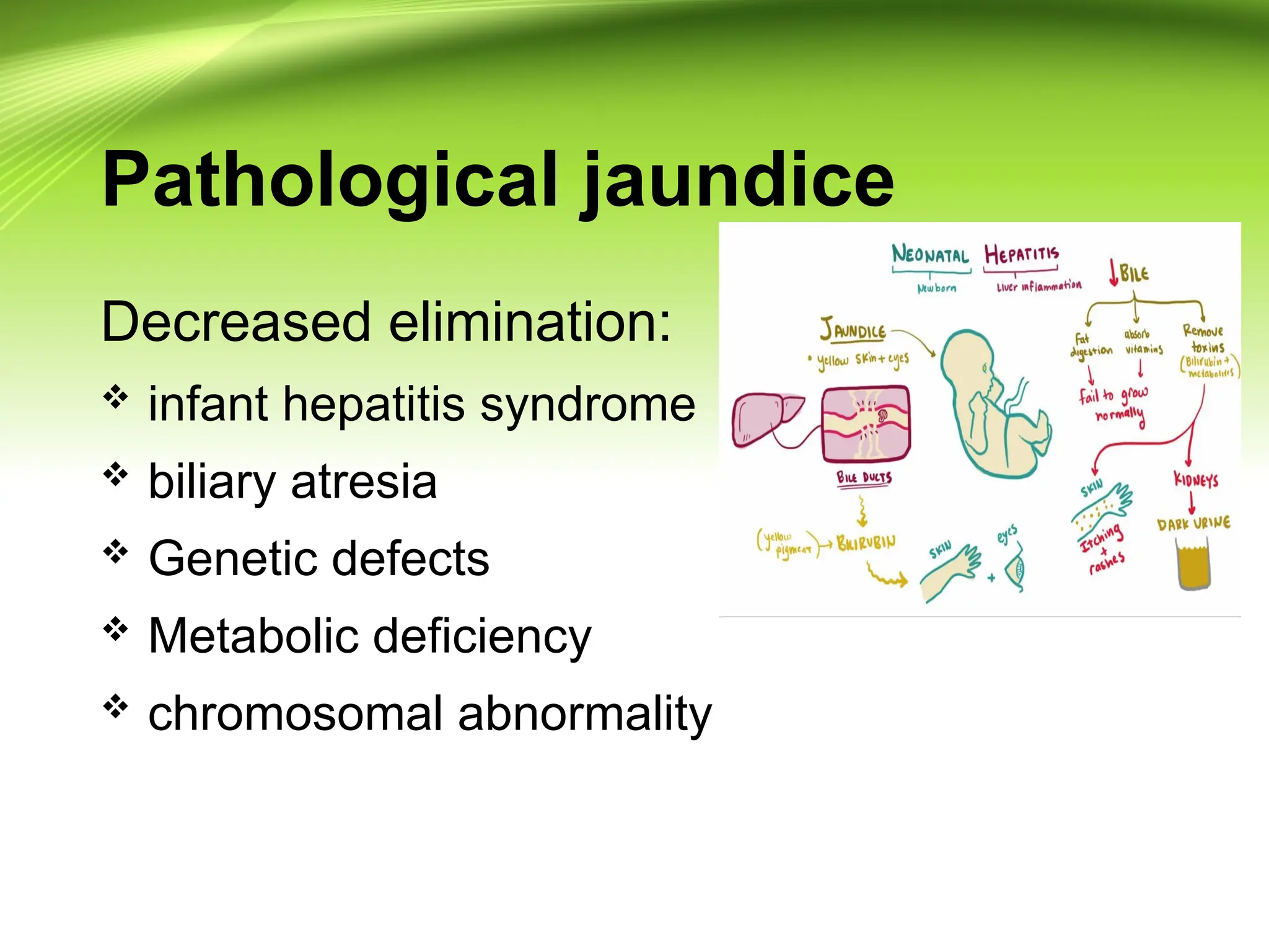 Pathological jaundice
Decreased elimination:
 infant hepatitis syndrome
 biliary atresia
 Genetic defects
 Metabolic deficiency
 chromosomal abnormality
 
