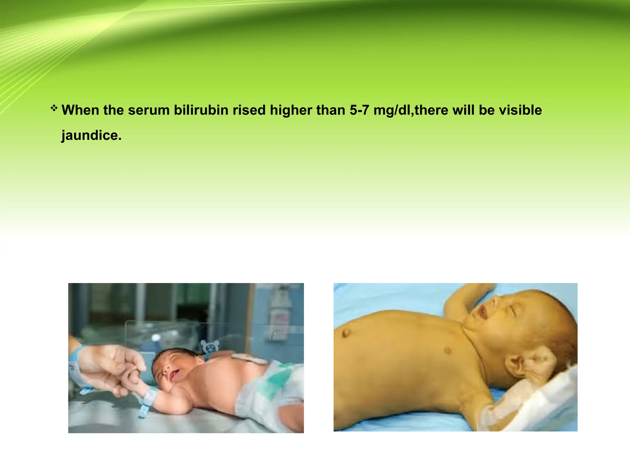  When the serum bilirubin rised higher than 5-7 mg/dl,there will be visible
jaundice.
 