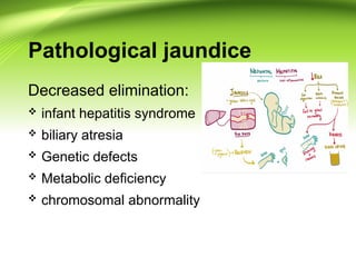 Pathologic Jaundice Neonatal Jaundice for the new borns .ppt
