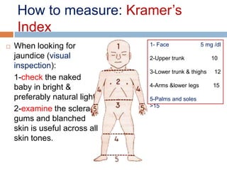 Kramer Test Neonatal Jaundice 1 | PPSX