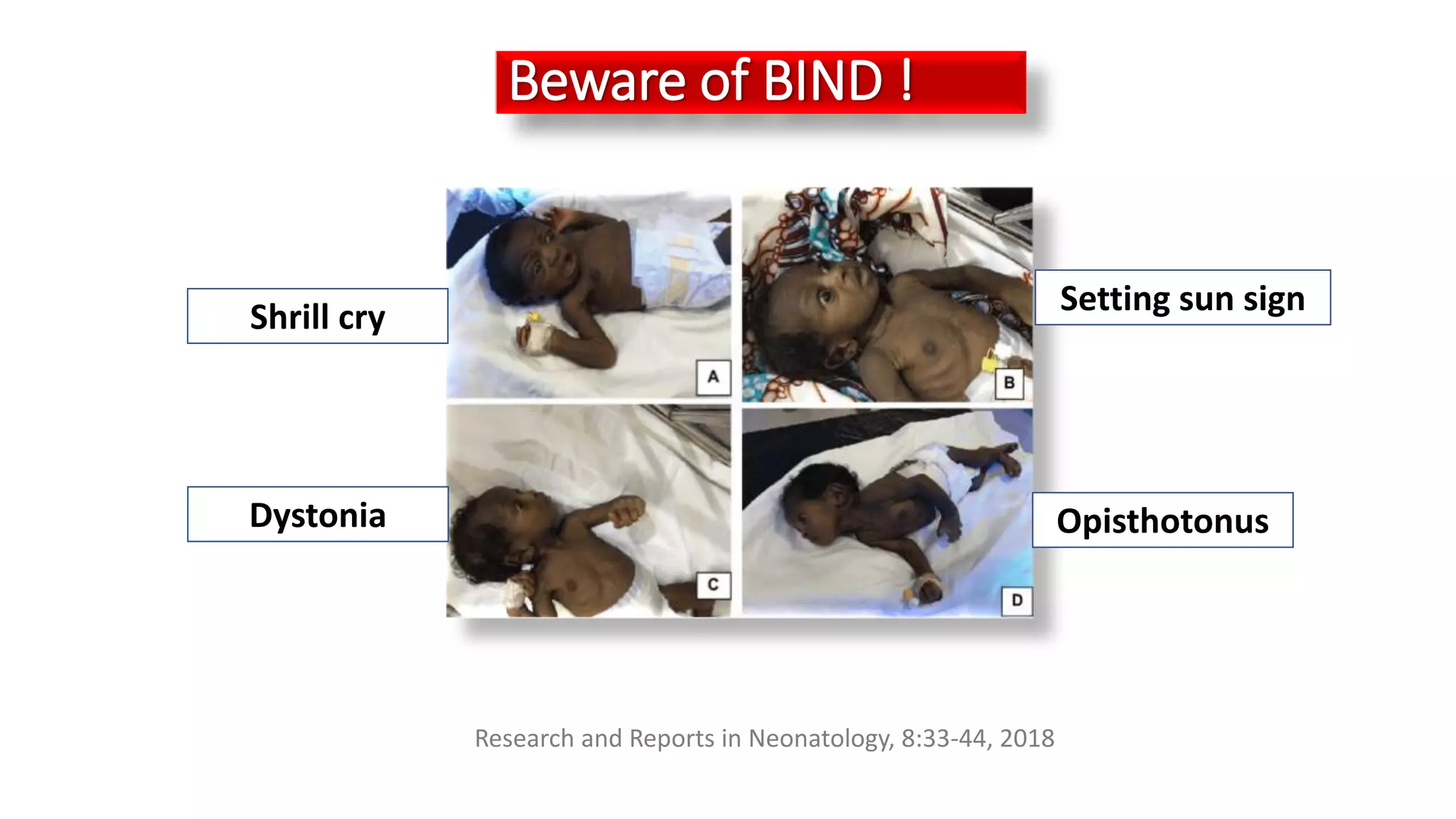 Beware of BIND !
Research and Reports in Neonatology, 8:33-44, 2018
Shrill cry Setting sun sign
Dystonia Opisthotonus
 