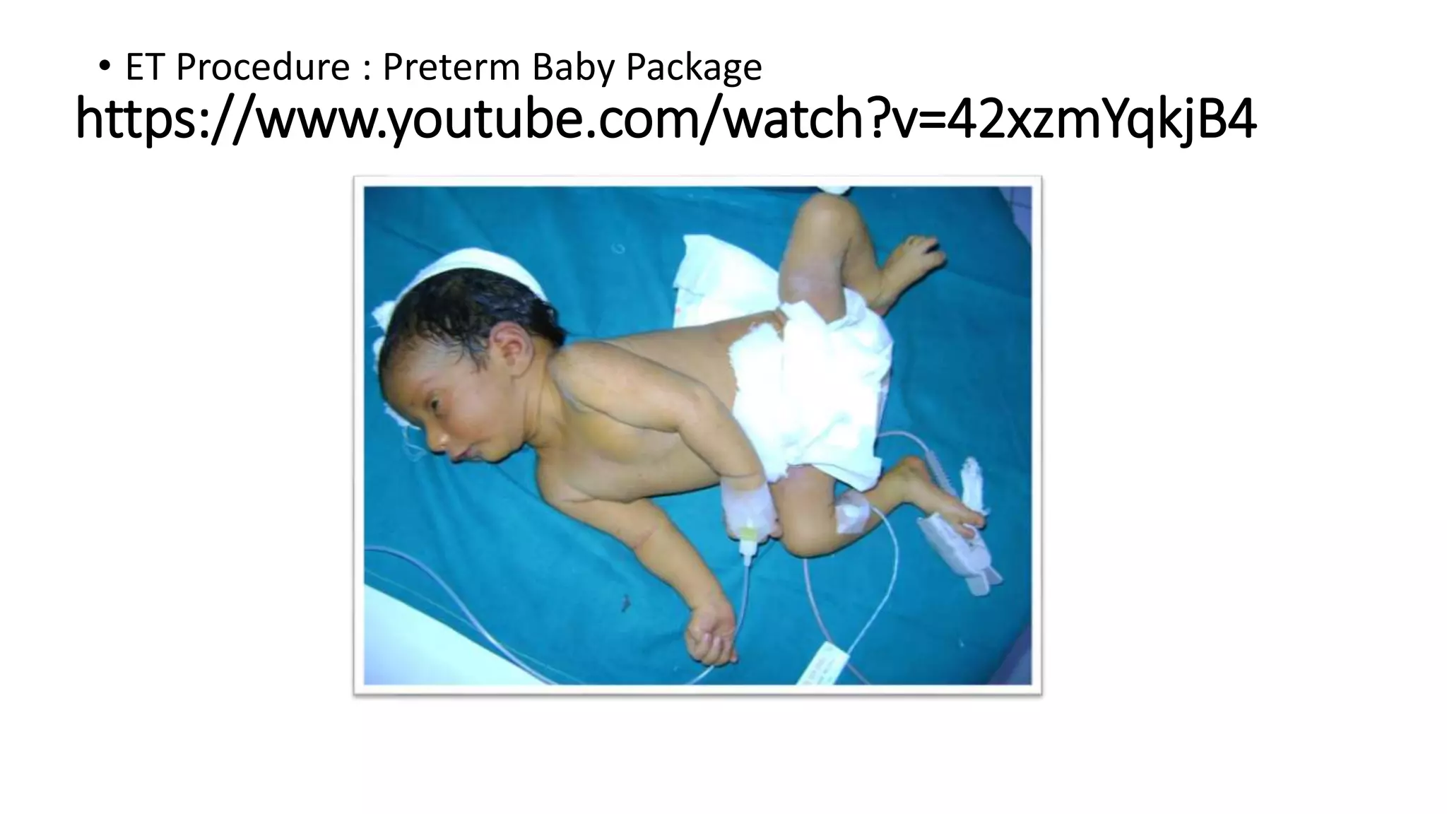 https://www.youtube.com/watch?v=42xzmYqkjB4
• ET Procedure : Preterm Baby Package
 