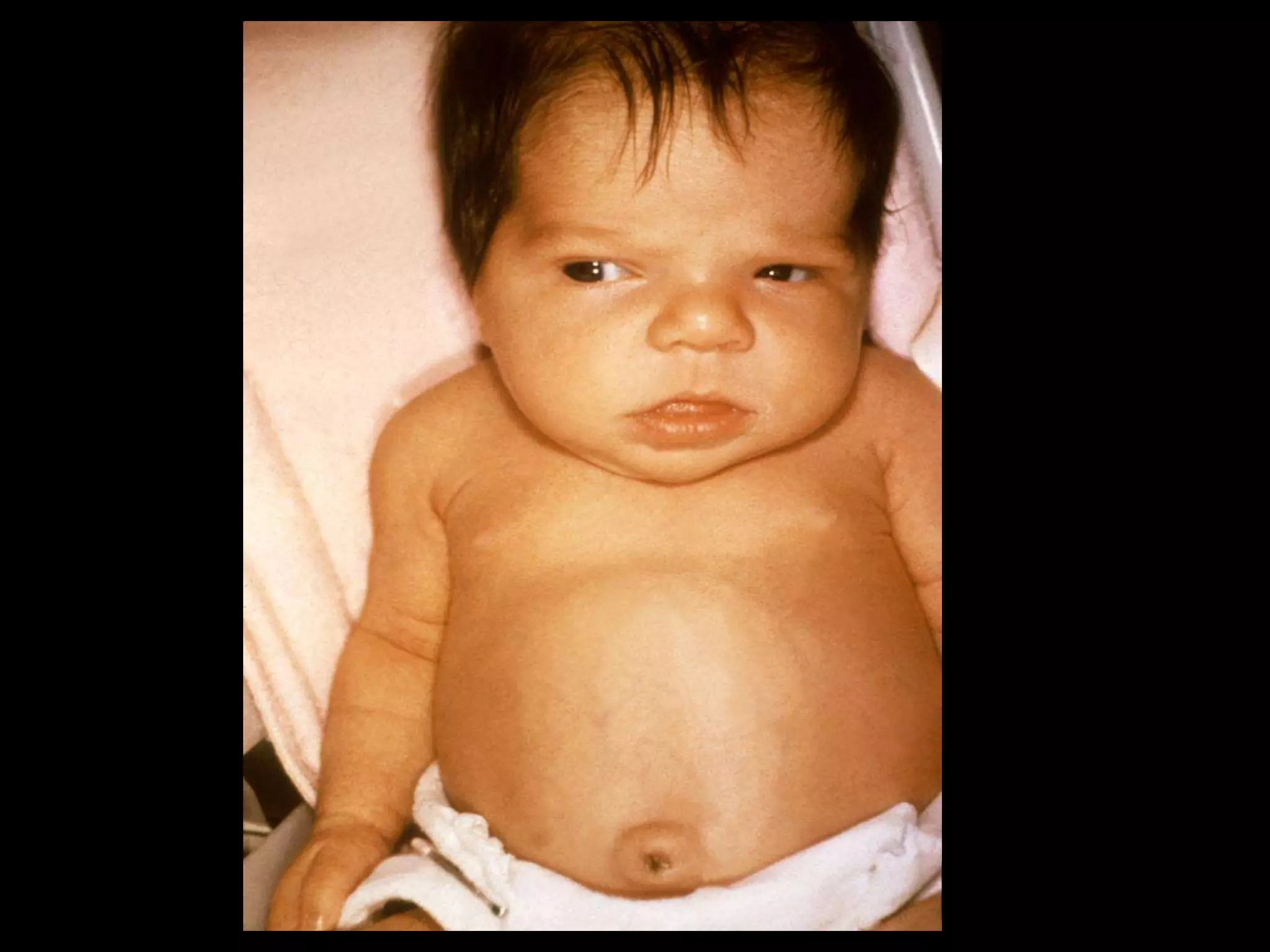 Neonatal jaundice (hyperbilirubinemia) by Rajiv Mavachi PPT