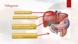 Increased RBC’s
Shortened RBC lifespan
Immature hepatic
uptake & conjugation
Increased enterohepatic
Circulation
Pathogenesis
 
