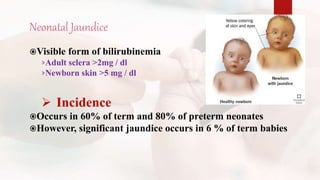 Neonatal Jaundice
Visible form of bilirubinemia
›Adult sclera >2mg / dl
›Newborn skin >5 mg / dl
 Incidence
Occurs in 60% of term and 80% of preterm neonates
However, significant jaundice occurs in 6 % of term babies
 