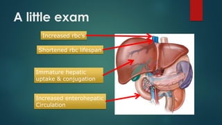 A little exam
Increased rbc’s
Shortened rbc lifespan
Immature hepatic
uptake & conjugation
Increased enterohepatic
Circulation
 