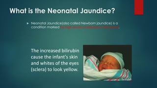What is the Neonatal Jaundice?
 Neonatal Jaundice(also called Newborn jaundice) is a
condition marked by high levels of bilirubin in the blood.
The increased bilirubin
cause the infant's skin
and whites of the eyes
(sclera) to look yellow.
 