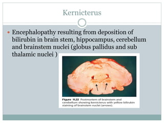Kernicterus
 Encephalopathy resulting from deposition of
bilirubin in brain stem, hippocampus, cerebellum
and brainstem nuclei (globus pallidus and sub
thalamic nuclei )
 