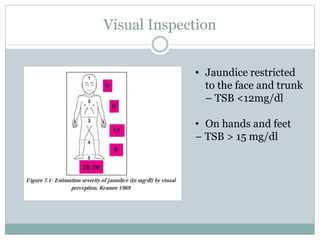 Visual Inspection
• Jaundice restricted
to the face and trunk
– TSB <12mg/dl
• On hands and feet
– TSB > 15 mg/dl
 