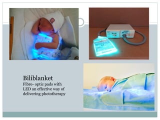 Biliblanket
Fibre- optic pads with
LED an effective way of
delivering phototherapy
 