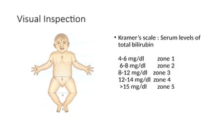 Kramer Test NEONATAL HYPERBILIRUBINEMIA, MANANGEMENT.pptx