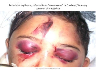 Periorbital erythema, referred to as “raccoon eye” or “owl eye,” is a very
common characteristic
19Prof Ariyanto Harsono M...