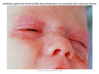 7Prof Ariyanto Harsono MD PhD SpA(K)
antibodies against the 50-kD La/SSB ribonucleoprotein are associated with cutaneous d...