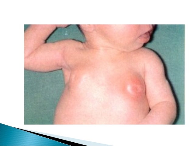 Thought bilateral breast buds Can bilateral breast buds