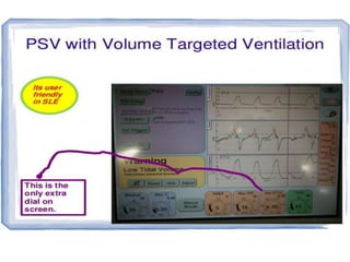 Volume guarntee(VG):
• Modified pressure targeted ventilation.
• Addition of microprocessor that adjusts the
pressure to ensure Targeted Tidal Volume(TTV).
• TV,Ti,Max PIP is set
• Flow sensor senses ex TV to adjust pressure for
next few breaths.
 
