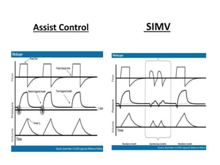 Assist Control SIMV
 