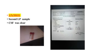 • 1/5/20221
• Second LP sample
• CSF was clear
 