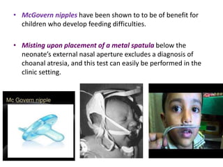 Neonatal nasal obstruction final