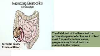 Terminal ileum/
Proximal Colon
The distal part of the ileum and the
proximal segment of colon are involved
most frequently; in fatal cases,
gangrene may extend from the
stomach to the rectum.
 