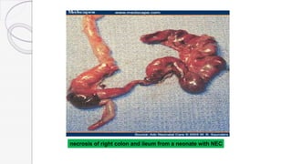 necrosis of right colon and ileum from a neonate with NEC
 