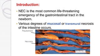 Introduction:
 NEC is the most common life-threatening
emergency of the gastrointestinal tract in the
newborn.
 Various degrees of mucosal or transmural necrosis
of the intestine occurs.
Pneumatosis
Necrosis
 