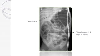 Portal Air
Dilated stomach &
loops of bowel
 