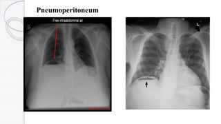 Pneumoperitoneum
 