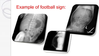 Example of football sign:
 