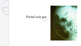 Portal vein gas
 