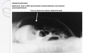 ◦ Intestinal perforation.
◦ Abdominal Xray in NEC demonstrates marked distention and massive
pneumoperitoneum
Free air below the anterior abdominal wall.
 