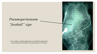 Pneumoperitoneum
“football” sign
◦ The median umbilical ligament and falciform ligament
are sometimes included in the description of this sign
 