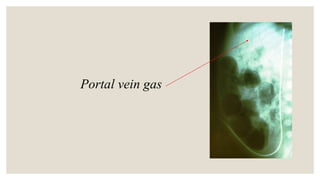 Portal vein gas
 