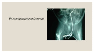 Pneumoperitoneum/scrotum
 