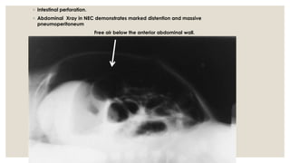 ◦ Intestinal perforation.
◦ Abdominal Xray in NEC demonstrates marked distention and massive
pneumoperitoneum
Free air below the anterior abdominal wall.
 
