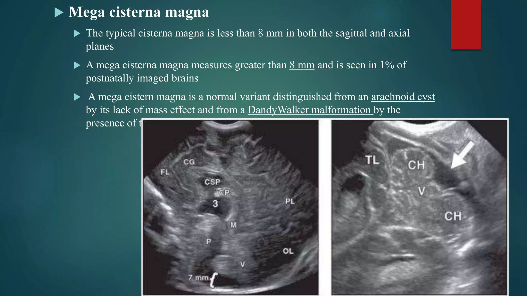 Neonatal neurosonography | PPTX
