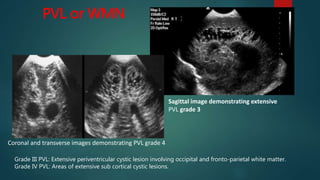 Chiari II Malformation
 Batwing configuration of frontal horns
 Small posterior fossa with low-lying tentorium
 Interdi...