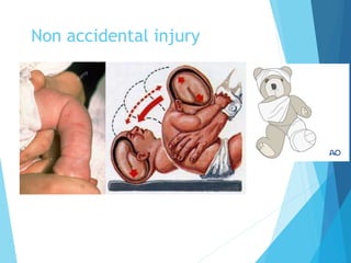 Non accidental injury
 