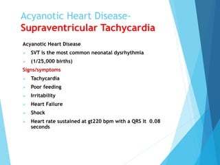 Acyanotic Heart Disease-
Supraventricular Tachycardia
Acyanotic Heart Disease
 SVT is the most common neonatal dysrhythmia
 (1/25,000 births)
Signs/symptoms
 Tachycardia
 Poor feeding
 Irritability
 Heart Failure
 Shock
 Heart rate sustained at gt220 bpm with a QRS lt 0.08
seconds
 