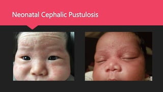 Neomatal Pustular Rash Rashes | PPTX