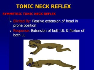 TONIC NECK REFLEX
SYMMETRIC TONIC NECK REFLEX

      Elicited By: Passive extension of head in
       prone position
      Response: Extension of both UL & flexion of
       both LL
 