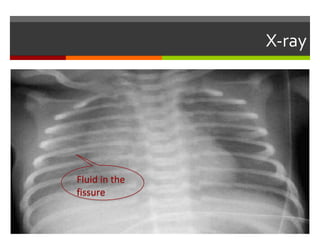 chest X-ray:TransientTachypnea of Newborn
Fluid in the
fissure
Fluid in the
fissure
 