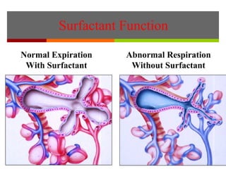 Normal Expiration
With Surfactant
Surfactant Function
Abnormal Respiration
Without Surfactant
 