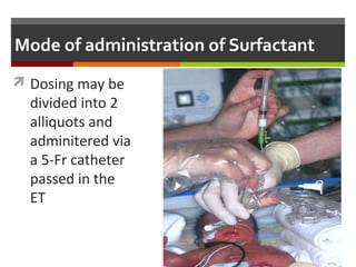 Mode of administration of Surfactant
 Dosing may be
divided into 2
alliquots and
adminitered via
a 5-Fr catheter
passed in the
ET
 
