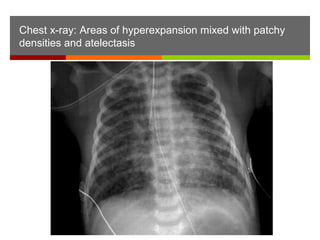 Chest x-ray: Areas of hyperexpansion mixed with patchy
densities and atelectasis
 
