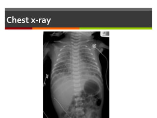 Management
In the DR or OR:
 Visualization of the vocal cords & tracheal suctioning before
ambu-bagging should be done only if the baby is not vigorous
In the NICU:
 Empty stomach contents to avoid further aspiration.
 Suction frequently & perform chest physiotherapy.
 