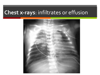 44
Chlamydia pneumonia with features of an interstitial
pneumonitis and characteristic widespread interstitial changes.
 